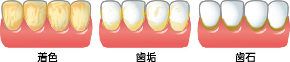 着色・歯垢・歯石